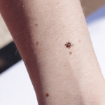 Tick bite