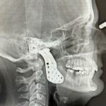 The X-ray shows the jaw and jaw joint implants.