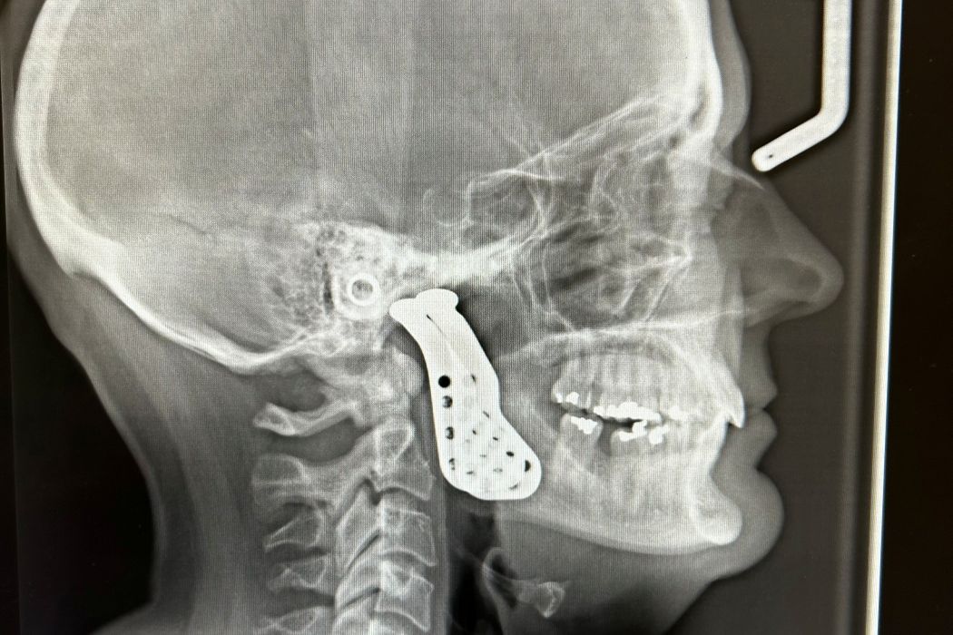 The X-ray shows the jaw and jaw joint implants.